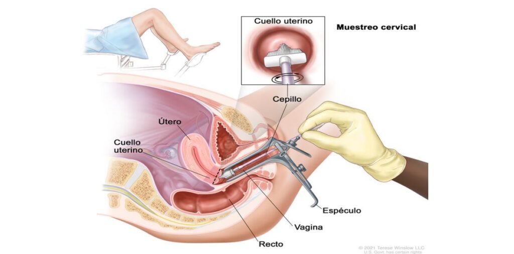 cáncer de utero